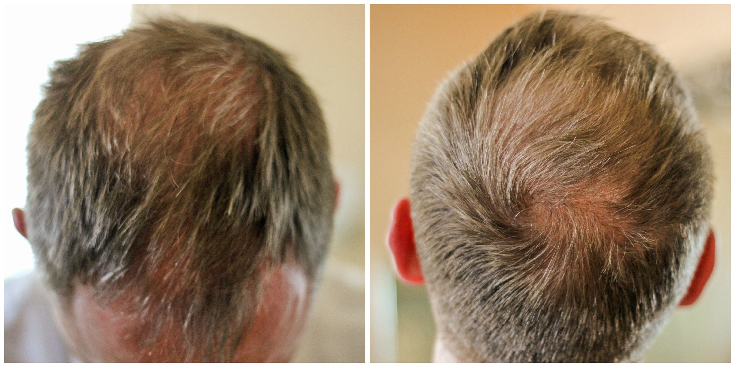 hair-thinning-and-hair-loss-what-s-a-man-to-do-clever-housewife