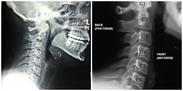 Side-by-side comparison of a normal cervical spine versus whiplash