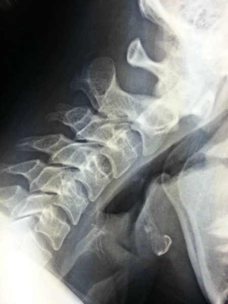 c-spine x-ray